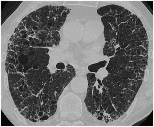 Figure 3. UIP-like comorbidity in a patient with sarcoidosis. CT scan shows a UIP-like pattern, with reticulations, bronchiectasis, and honeycombing with a basal and peripheral predominance in a patient with confirmed sarcoidosis.