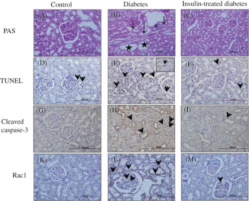 Figure 1.  Photomicrograph kidney sections from control (A), diabetic (B), and insulin-treated diabetic rats (C) PAS stain. It was observed normal morphologic structure in PAS-stained control group kidney specimens (A). Mesangial matrix expansion, loss of proximal tubulus brush border, inflamatory cell infiltration in interstitial tissue, degeneration in renal tubulus, and vacuolization were observed in diabetic group (B). Insulin-treated diabetic group, these degenerative changes were mainly prevented (C). TUNEL (+) cells and cleaved caspase-3 expressions in diabetic (tubulointerstitial area and glomerular area) group (E and H) were increased according to control (D and G) and insulin-treated diabetic groups (F and I). Rac1 immunoreactivity was showed moderate positivity in tubulointerstitial area and glomerular area in diabetic group (L), weak positivity was found both in control (K) and insulin-treated diabetic groups (M).