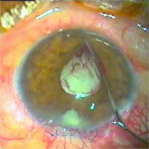 Figure 1 Intraoperative small hemorrhages during manual dilation of small pupil.