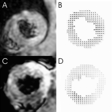 Figure 1. Example end-systolic magnitude images for one mouse at (A) baseline and (C) day 1. Also shown are their corresponding displacement maps (B, D). The areas of contrast enhancement in (C) correspond well with regions of reduced displacement in (D).