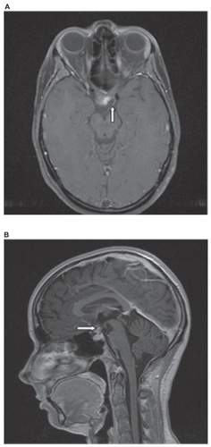 Figure 3 A) MRI, axial section, T1-weighted images after administration of gadolinium: the irregular contrast enhancement (arrow) can be seen. B) MRI, sagittal section, T1-weighted image after administration of gadolinium: the enlarged chiasma suprasellar above the pituitary gland can be seen.