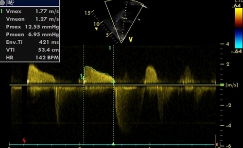 Figure 6 Post-procedure transthoracic echocardiography CW Doppler across the mitral valve.