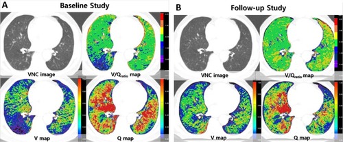 Figure 2 A 68-year-old male COPD patient. On a VNC image of xenon ventilation CT, minimal centrilobular emphysema and bronchial wall thickening are notable in bilateral lungs. (A) On baseline study, ventilation is decreased in the superior segment of right lower lobe, while perfusion is preserved resulting in the reversed mismatched V/Q pattern on the V/Qratio map. (B) On follow-up images, ventilation is improved in this area resulting in the matched V/Q pattern on V/Q map. In both upper lobes and left lower lobes, ventilation and perfusion are preserved or relatively increased resulting in the matched V/Q pattern on baseline images, and the matched V/Q pattern is not changed on follow-up. In this patient, quantified V was increased from 0.461 to 0.530 and quantified V/Qratio was increased from −0.888 to −0.462. FEV1 was changed by 0.24 L in this patient on follow up.