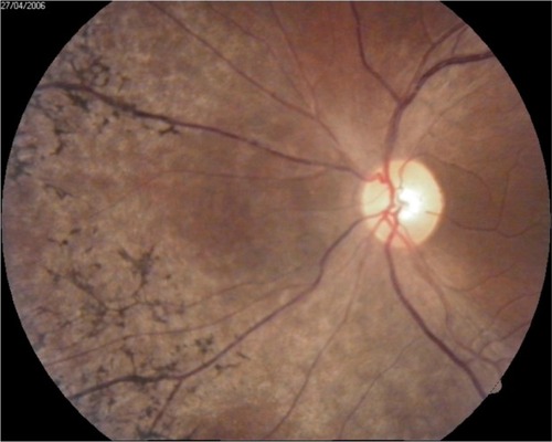 Figure 5 Retina and optic disc in OS.