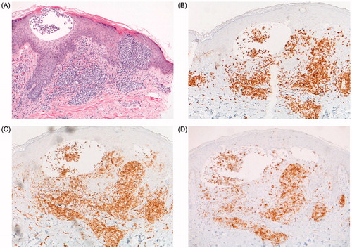 Figure 2. Histopathology and immunophenotyping of punch biopsy from the left thigh. (A) Hematoxylin-Eosin biopsy section showing epidermotropic ATLL. (B) CD3, (C) CD4, (D) CD25 immunohistochemistry supporting the diagnosis of ATLL.