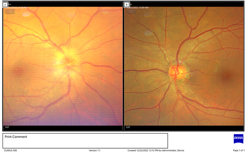 Figure 3 Fundus photography of (A) right eye; swollen optic nerve head and (B) left eye; normal optic nerve head.