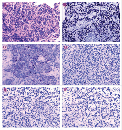 Figure 1. (A) Hematoxylin-Eosin staining of the thymic mass showed tumor cells grew diffusely. Immunohistochemical analysis demonstrated the tumor cells were strongly positive for (B) P63, (C) cytokeratins 5/6, immunostaining revealed negative for (D) CD56, (E) synaptophysin and (F) NapsinA respectively.