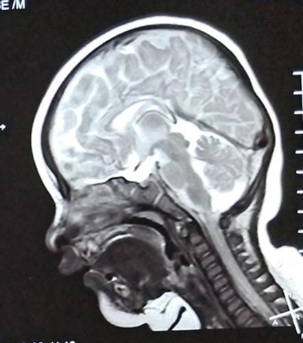 Figure 1 Brain MRI showed agenesis of the corpus callosum.