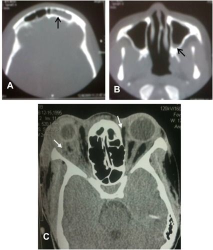 Figure 2 (A) Frontal sinusitis, (B) maxillary sinusitis, and (C) bilateral intraorbital abscesses.