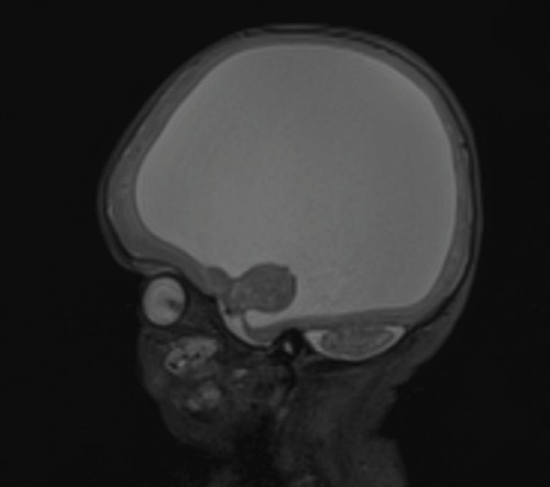 Figure 3 Sagittal T2-weighted image showing thin rim of brain parenchyma, with a cobblestone appearance of the cortex and pontine and cerebellar hypoplasia.