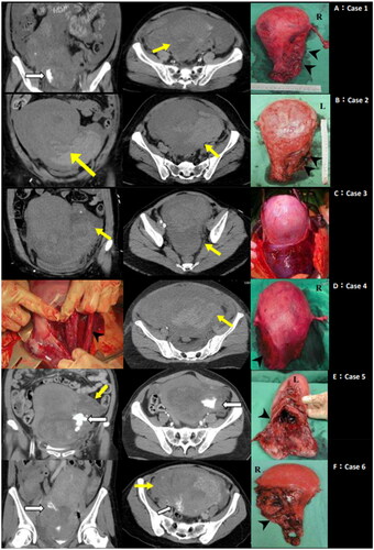 Figure 3. Abdominal computed tomography images and intraoperative findings in our study (N = 6). Each case is dipicted in panel A to F. A: Contrast extravasation (white arrow), and myometrium disruption with intraperitoneal hematoma formation (yellow arrow) observed on contrast-enhanced abdominal computed tomography. This corresponds to the location of uterine rupture site (black arrowhead). B : Abdominal computed tomography following trans-arterial embolization displaying myometrium disruption with intraperitoneal hematoma formation (yellow arrow) consistent with the uterine rupture site (black arrowhead). C : Contrast-enhanced abdominal computed tomography following trans-arterial embolization, revealing myometrium disruption with concealed subserosal hematoma formation (yellow arrow) leading to engorgement of the lower uterine segment. D: Abdominal computed tomography after failure of attempted trans-arterial embolization, demostrating myometrial disruption and intraperitoneal hematoma (yellow arrow) in line with the uterine rupture site. Also indicating direct uterine vessel injury after operative vaginal delivery (black arrowhead). E: Contrast extravasation (white arrow), and myometrial disruption with intraperitoneal hematoma formation (yellow arrow) on contrast-enhanced abdominal computed tomography, corresponding to the uterine rupture site (black arrowhead). (L, left; R, right)