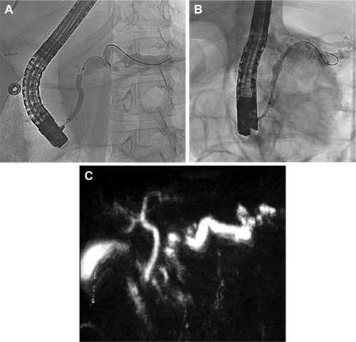 Figure 1 Radiographic findings in hereditary pancreatitis.