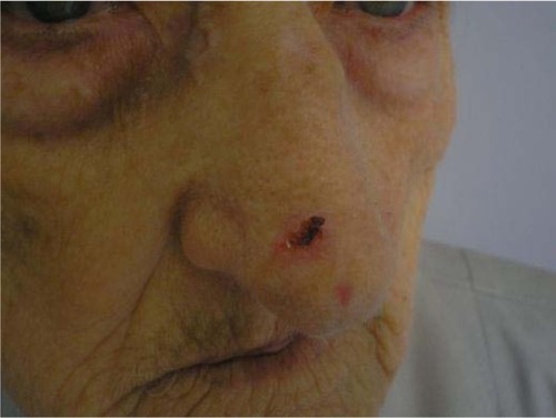Figure 7 A small bleeding tumor covered by crust on the nose, multiple actinic keratosis on the face.