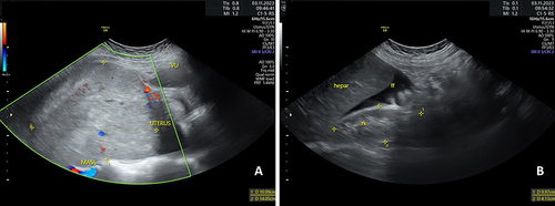 Figure 2 Patient’s abdominal ultrasonography. (A) Suspected solid ovarian mass with colour Doppler +1; (B) Free fluid present on Morrison pouch.