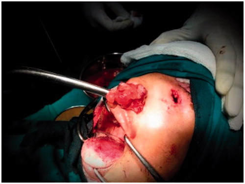 Figure 4. Complete excision and clearance of the sinuses in piece-meal fashion.
