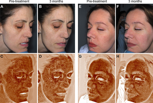 Figure 5 Topographic skin complexion analysis using the Reveal imaging system. Cross polarized (A, B, E and F) and RBX Brown (C, D, G and H) images are displayed. Patients presented slight reduction in hyperpigmented spots after ES therapy.
