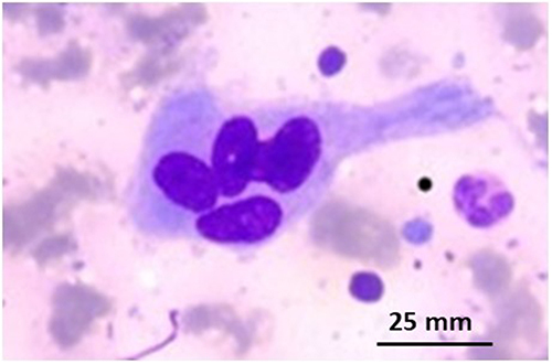 Figure 4 Small multinucleated giant cell with 5 nuclei (Giemsa, x400).
