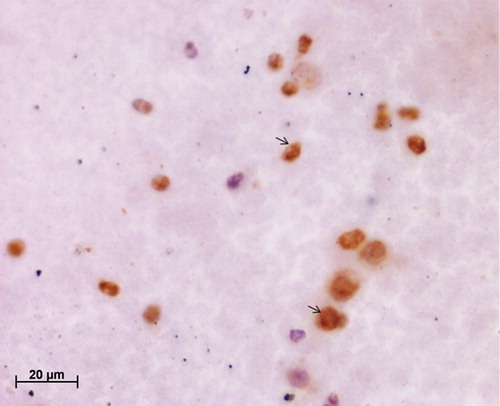 Figure 4. Immunocytochemical staining of cervical smear with PCNA antibody using the modified protocol exhibiting PCNA-positive cells with improved visualization.