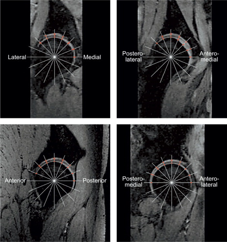 Figures 17. Method 3: Four reconstructed images through the centre of the femoral head were used. This consisted of a sagittal, a coronal and two images placed 45° between coronal and sagittal. On each of the four images, a grid of 15–20 radial test lines was selected and superimposed on the images, and where the test lines intercepted the cartilage, the orthogonal distance through the cartilage was manually measured. The approximately 60-80 measured distances were summed, and the mean thickness of the acetabular and femoral cartilage was calculated.