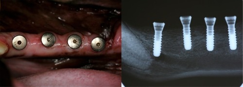 Figure 4 Clinical photograph and the corresponding radiograph at 12 weeks postsurgery.Notes: The four implant sites healed unsubmerged. The peri-implant soft tissues showed no clinical signs of overt inflammation. The radiograph picture showed good osseointegration.