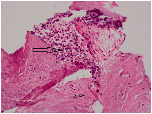 Figure 2. H&E stained sections of the peritoneal biopsy showing fibrosis (small arrow) with neutrophilic exudates (big arrow).