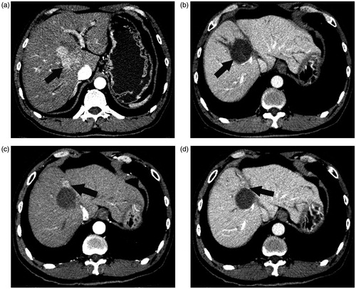 Figure 4. HCC in a 57-year-old patient. (a) The image obtained by CECT before thermal ablation indicates a lesion diameter of 4.1 cm in segment VIII, with hyper-enhancement in the arterial period (arrow). (b) One month after thermal ablation, the ablated area did not exhibit enhancement in CECT (arrow), which confirms complete ablation of the tumour. The diameter of the ablated area was 4.2 cm. We calculated a safety margin of 0 cm. (c) and (d) Approximately 7.1 months after ablation, the arterial phase in CECT revealed nodular hyper-enhancement at the lateral margin of the ablated area, which indicates LTP (arrow); washout of this nodule was observed in the portal venous phase of CECT.