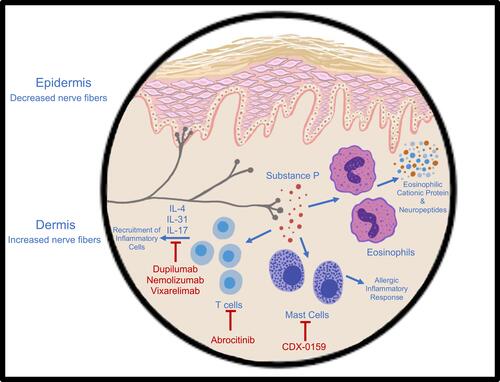 Figure 1 A summary of the pathogenesis of prurigo nodularis and the targets of novel immunotherapies dupilumab, nemolizumab, vixarelimab, CDX-1059, and abrocitinib.