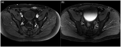 Figure 2. MRI (T1 FS SPIR sequence with contrast) of lower abdomen with desmoid within the left lower rectus abdominis muscle: (a) before treatment and (b) five years after treatment with no residual tumor.