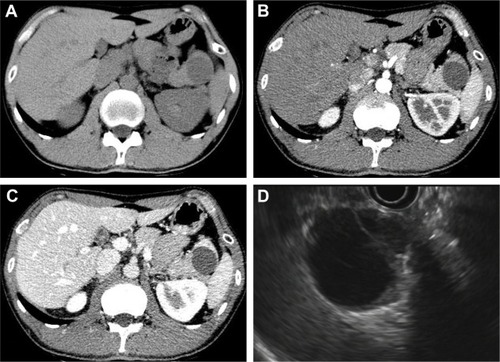 Figure 1 The abdominal computed tomography (CT) scan confirmed a well-defined cystic neoplasm in the pancreatic tail (A), without enhancement in the arterial phase (B) and the portal phase (C). Endoscopic ultrasonography (EUS) showed a 3.5 cm multilocular cystic lesion in the pancreatic tail with an internal nodule (D).