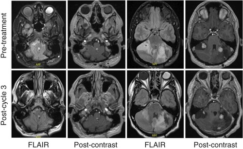 Figure 2. Pre- and post-treatment MRI imaging for patient 2. The time interval between scans was 4 months, and the patient had received three cycles of belzutifan. Panels show fourth ventricular mass and multiple cerebellar hemangioblastomas, with interval reduction in perilesional edema and reduced contrast enhancement.FLAIR: Fluid-attenuated inversion recovery.