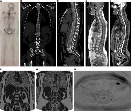 Figure 3 A 38-year-old female patient diagnosed with bilateral breast cancer in 2015 underwent a bilateral mastectomy and left axillary dissection in September 2015. Notes: The patient received chemotherapy from October 2015 to March 2016 and radiotherapy in June and July 2016 (28 sessions). She had already been treated with anastrozole and goserelin (March 2016 to June 2017) and initiated use of capecitabine in June 2017 and zoledronic acid in August 2017. She currently complains of lumbar pain. In (A), bone scintigraphy shows an unspecific and discrete focus of uptake in the left iliac crest. In (B) and (C), coronal and sagittal reformatted CT (June 2016) shows sclerotic areas in some vertebrae, the sternum, and ilium and partial collapse of L5, suggestive of lumbar metastasis. Whole-body MR showing discrete hypointense areas in sagittal T1 (D), without expression in sagittal STIR (E), and partial replacement of these lesions by fatty marrow in fat-fraction coronal T1 sequences (F and G). The diffusion-weighted sequence (b800) in inverted grayscale in the axial plane (H) shows no active lesions with diffusion restriction. The set of MR findings suggests lesions with a predominance of therapeutic response.Abbreviations: CT, computed tomography; MR, magnetic resonance; STIR, short-tau inversion-recovery.