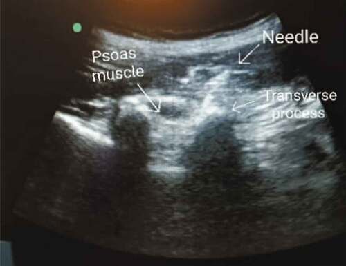 Figure 1. Lumbar paravertebral block
