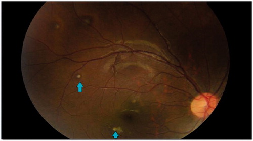 FIGURE 2. Multifocal creamy white, well circumscribed lesions seen in the choroid (arrow pointing to the lesions) during the first eye visit.