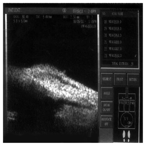 Figure 8 Ultrasonic biomicroscopy image for medium reflectivity in a case of the group with BCECF-AM (group A).