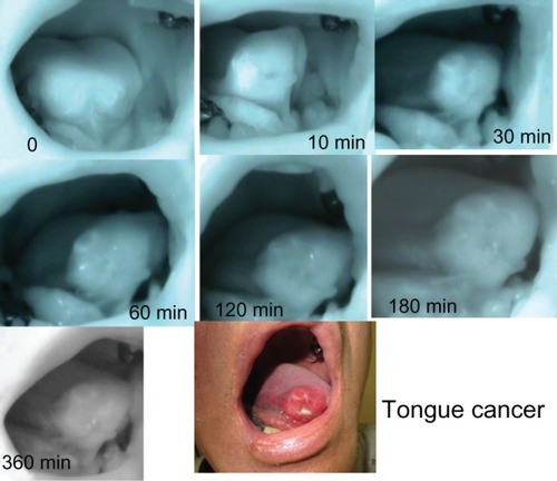 Figure 1 Changes in ICG fluorescence images in tongue cancer.