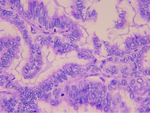 Figure 1 High-power magnification of a tumor specimen shows adenocarcinoma (400×).