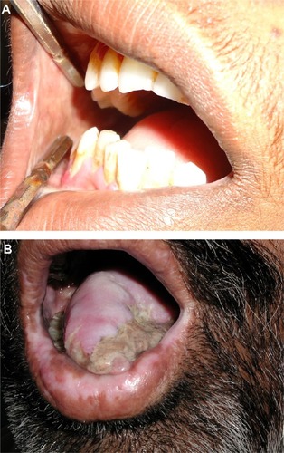 Figure 7 Advanced-stage oral submucous fibrosis.