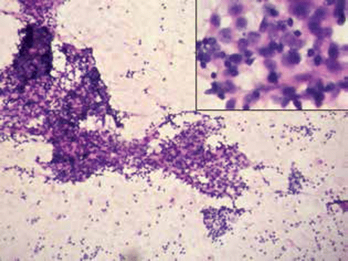 Figure 3: The microscopic appearance of aspirate from the psoas abscess, showing sheets of malignant squamous cells with a hyperchromatic nucleus and conspicuous nucleoli (inset), using haematoxylin and eosin staining