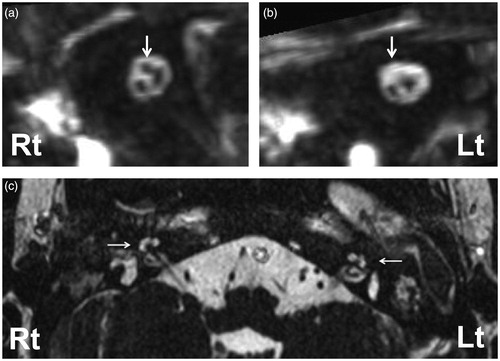 Figure 2. Oblique sagittal MPR, composed from 3D-CISS MRI (heavily T2 weighted images) of internal auditory canal (IAC) (a: right, b: left) demonstrates hypoplasia of the left facial nerve (b arrow) compared to the right side. The right facial nerve is obvious in the IAC (a arrow) but the left facial nerve is almost absent (b arrow). The cochleae of both sides are normally shaped.