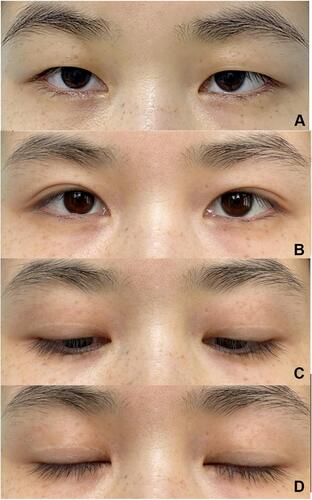 Figure 4 Patient 1. (A) Preoperative view of a 28-year-old female with puffy upper eyelids who underwent double-eyelid blepharoplasty with TOS fixation. Postoperative views at twelfth month with her eyes open (B), eyes gazing downward (C), and eyes closed (D).