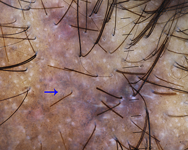 Figure 9 Trichoscopy of lichen planopilaris shows target sign (blue arrow).