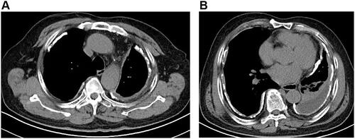 Figure 1 Mediastinal windows of computed tomography (A and B) confirm the previously noted bilateral pleural thickening, calcification. There is associated left lobe Pleural effusion and atelectasis.