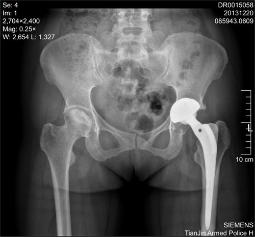 Figure 2 Pelvis images of bilateral hips from a 35-year-old female patient who received left artificial hip joint replacement.