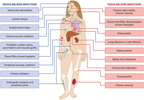 Figure 1 Pathogenic microbial biofilms contaminated biomaterials and biomedical devices induced infections.