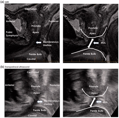 Figure 1. (a) Preoperative T2-weighted midsagittal MRI image and (b) Transperineal ultrasound image for a single patient. Preoperative membranous urethral length (MUL) is measured from the prostatic apex to the point of entry of the membranous urethra at the penile bulb.