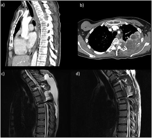 Figure 5. Case of malignant thoracic spine tumour with pre-operative CT images showing the paravertebral metastatic uterine leiomyosarcoma in sagittal (a) and axial (b) views. An MRI sagittal view of the CSF leak after the first operation is displayed in c), with a subsequent MRI after operative exploration, repair and CSF diversion shown in d).Citation28,Citation29