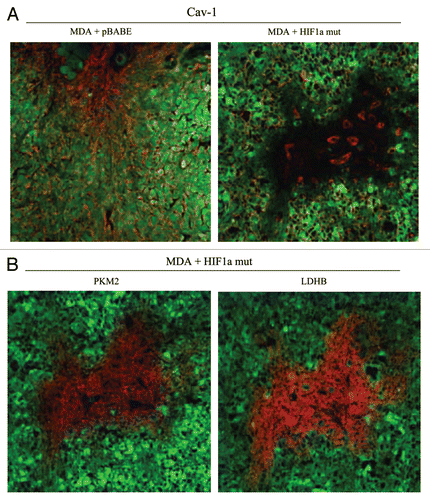 Figure 12 Activated HIF1a downregulates Cav-1 in the tumor stromal compartment: Stromal co-localization with PKM2 and LDHB. (A) Cav-1 immunostaining. To assess whether expression of activated HIF1a in fibroblasts results in mammary tumors with a Cav-1 negative fibroblastic stromal compartment, consecutive frozen sections were cut from mammary tumors that were grown with fibroblasts expressing activated HIF1a. Note that Cav-1 expression is substantially reduced in the stromal compartment of these tumors, but is selectively retained in the micro-vasculature (endothelial cells), exactly as is observed in human breast cancers in vivo. Tumor cells are marked by GFP (green fluorescence). (B) PKM2 and LDHB immunostaining. The presence of these Cav-1 negative fibroblasts was confirmed in consecutive sections (compare with part A, shown at right) by employing antibodies directed against glycolytic enzymes, such as PKM2 and LDHB. Note that PKM2 and LDHB immuno-staining nicely coincides with the Cav-1 negative stromal area in these MDA-MB-231 tumor tissue sections, and does not significantly overlap with the tumor cells which are marked by GFP (green fluorescence).