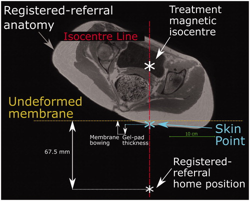 Figure 5. Method used to predict the transducer’s anterior-posterior home position in a registered-referral imaging dataset. The treatment dataset magnetic isocentre is known because the registered-referral imaging dataset had been registered to the treatment imaging dataset. A line was drawn downwards from the treatment dataset isocentre and intersected the skin at the skin point. From this skin point, the home position was calculated using the average compressed gel-pad thickness, the average membrane bowing distance, and the calibrated distance between undeformed membrane and home position of 67.5 mm (see Figure 3).