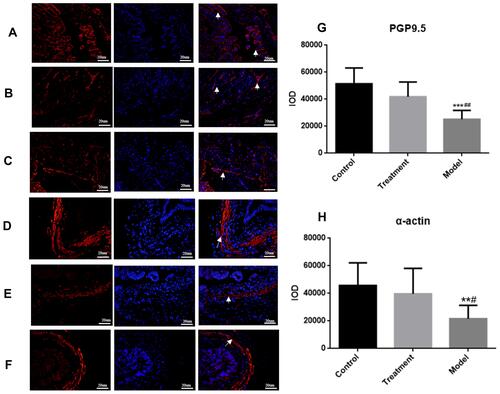 Figure 4 (A) Normal group, (B) Model group, (C) Treatment group: Rabbit SO tissue, nerve fiber PGP9.5 in the inner muscular layer detected by laser confocal microscopy, red light is PGP9.5, blue light is DAPI. (D) Normal group, (E) Model group, (F) SGD treatment group: α-actin labeled rabbit SO tissues were examined by laser confocal microscopy (400×, 20 um), with α-actin in red light and DAPI in blue light. (G) fluorescence intensity of PGP9.5 (IOD) in the SO tissue of rabbits in each group; (H) The fluorescence intensity (IOD) of α-actin labeled SMC in the SO tissue of rabbits in each group. Arrows indicate positive expression.*** indicates the comparison between the model group and the control group, P<0.05, ##indicates the comparison between the model group and the treatment group, P<0.05. In α-action, ** indicates the comparison between the model group and the control group, P<0.05, # indicates the comparison between the model group and the treatment group, P<0.05.