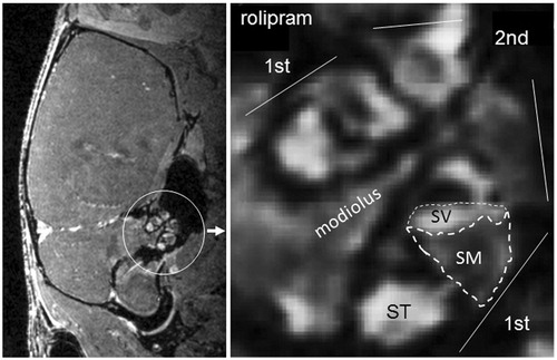 Figure 1. Magnetic resonance imaging and quantitative assessment of gadolinium in endolymphatic relative perilymphatic space. Sagittal section of the mouse brain showing the inner ear and the contrast enhancement in the cochlea (left). To evaluate the effect of spironolactone on EH in different contexts, the size of the endolymphatic fluid compartment, the relative area of scala media in the basal turn of the cochlea, was estimated by calculating the ratio between scala media (noncontrast enhanced, lower dotted area) and scala media + scala vestibule (scala vestibule, upper dotted area, is contrast enhanced) (right). The ratio of areas is subsequently converted to percentage as shown in Figures 2–4. SV: scala vestibule; ST: scala tympani; SM: scala media; 1st: first turn; 2nd: second turn.